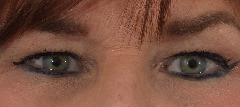 Blepharoplasty Before & After Gallery - Patient 69039178 - Image 1