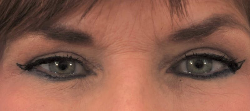 Blepharoplasty Before & After Gallery - Patient 69039178 - Image 2