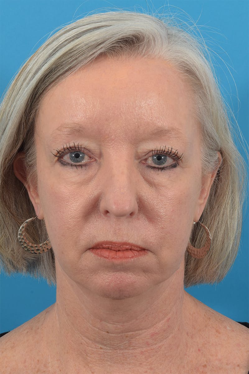 Blepharoplasty Before & After Gallery - Patient 69039179 - Image 1