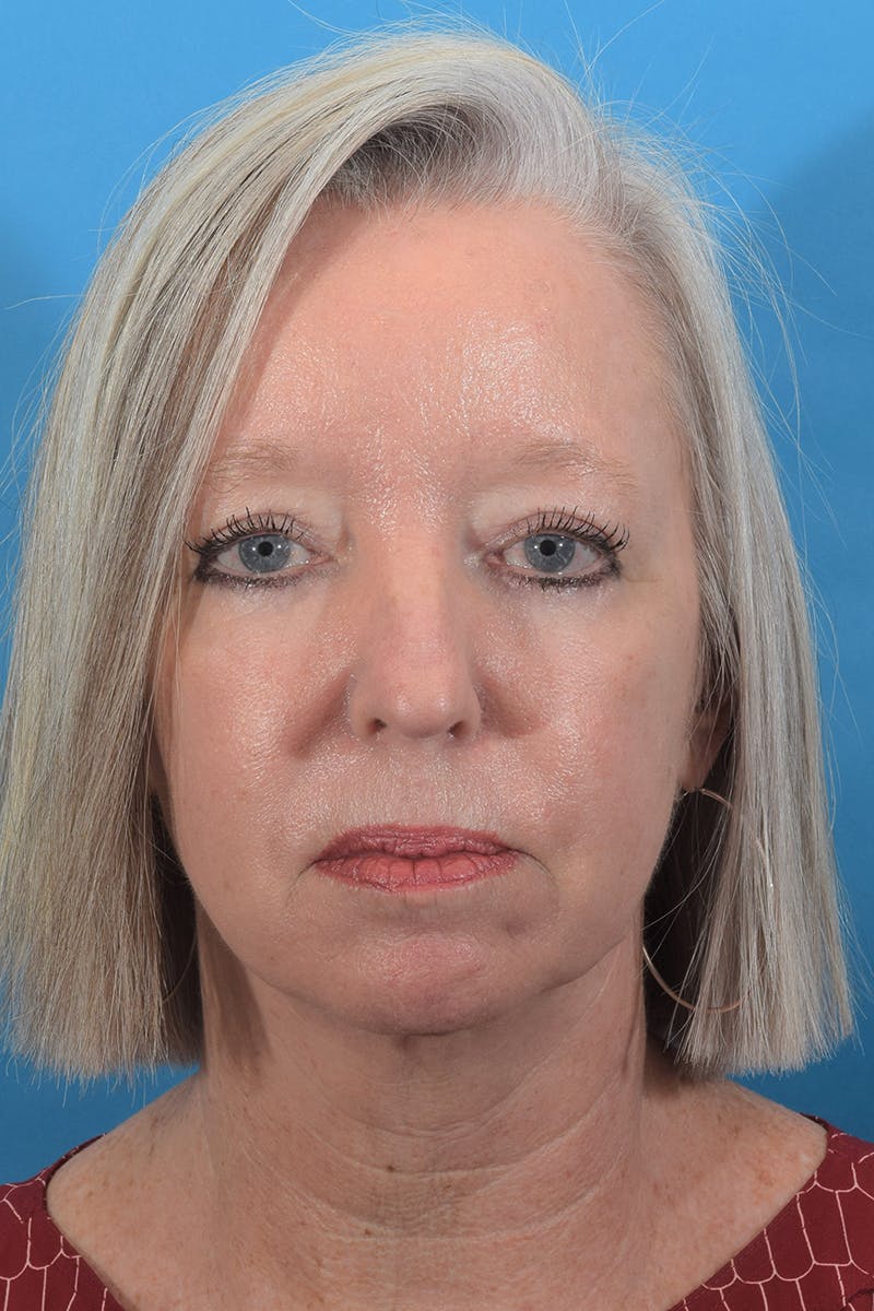 Blepharoplasty Before & After Gallery - Patient 69039179 - Image 2