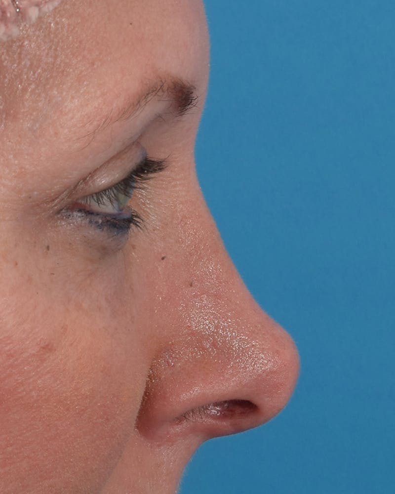 Rhinoplasty Before & After Gallery - Patient 71345269 - Image 1
