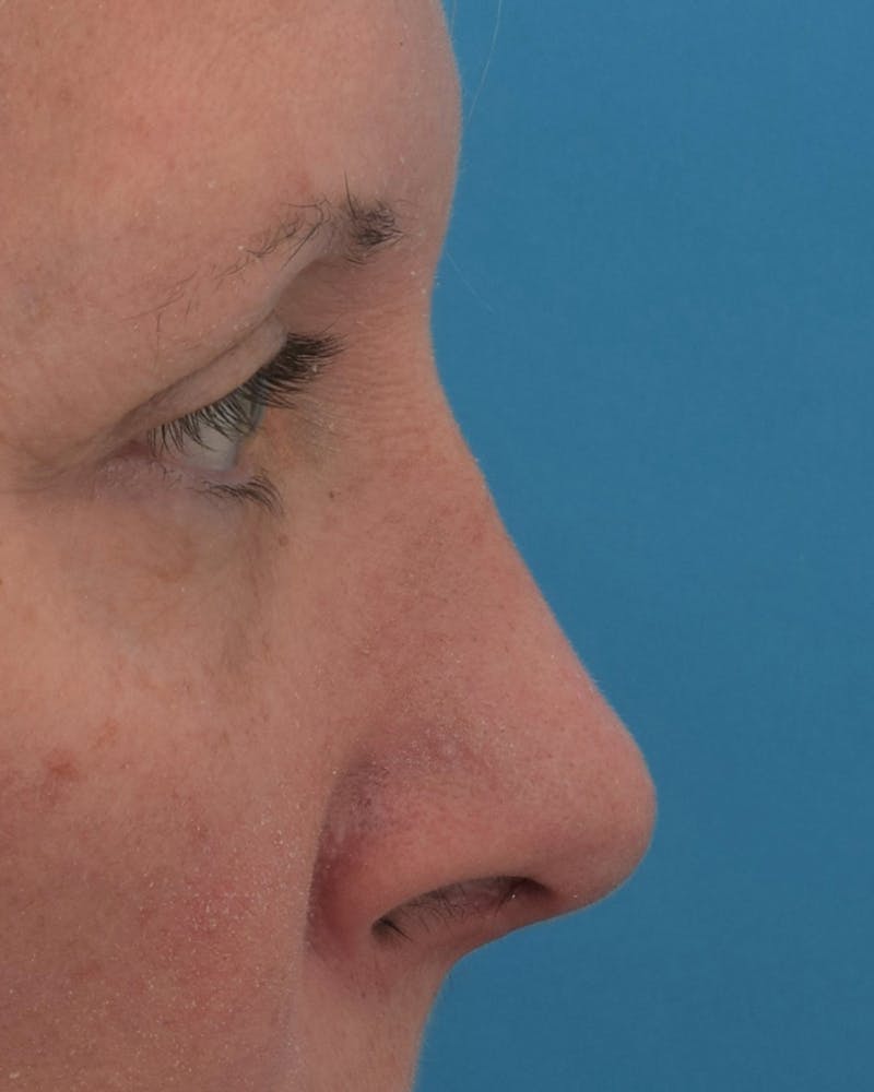Rhinoplasty Before & After Gallery - Patient 71345269 - Image 2