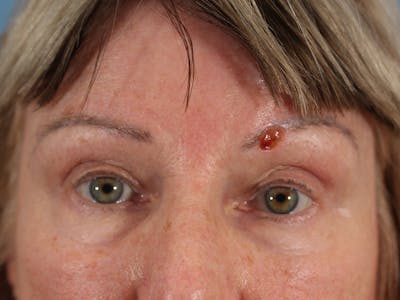 Skin Reconstruction Before & After Gallery - Patient 72130842 - Image 1