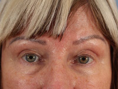 Skin Reconstruction Before & After Gallery - Patient 72130842 - Image 2
