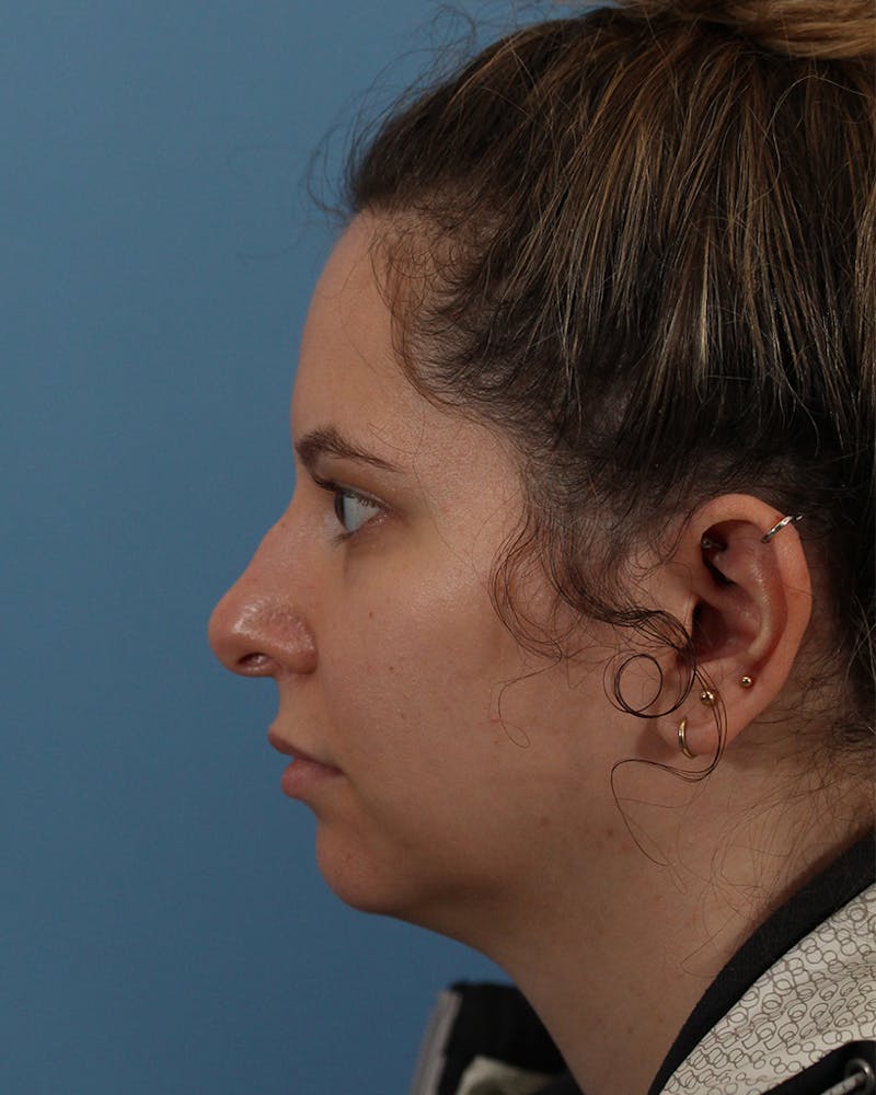 Rhinoplasty Before & After Gallery - Patient 82228156 - Image 1