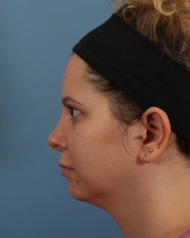 Rhinoplasty Before & After Gallery - Patient 82228156 - Image 2