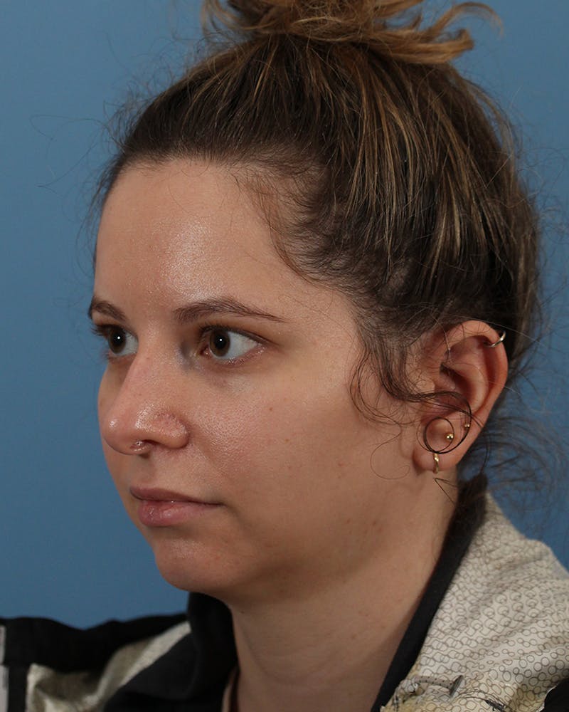 Rhinoplasty Before & After Gallery - Patient 82228156 - Image 3