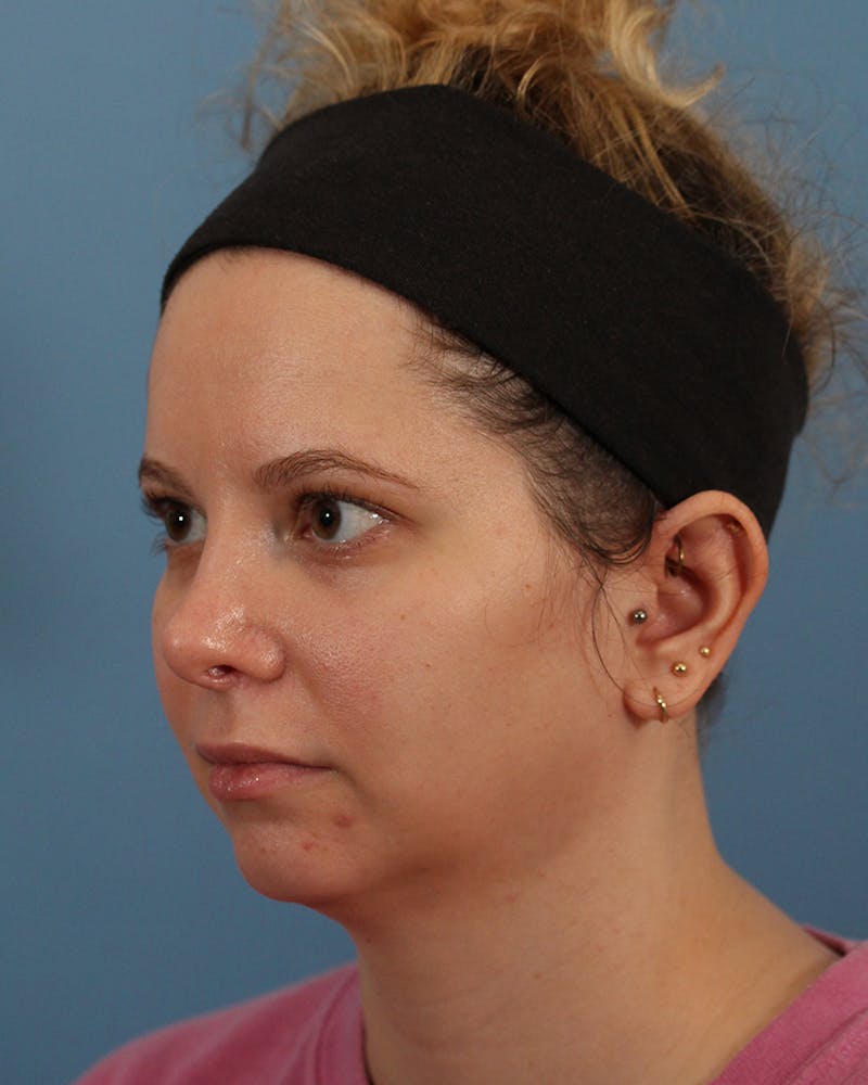 Rhinoplasty Before & After Gallery - Patient 82228156 - Image 4