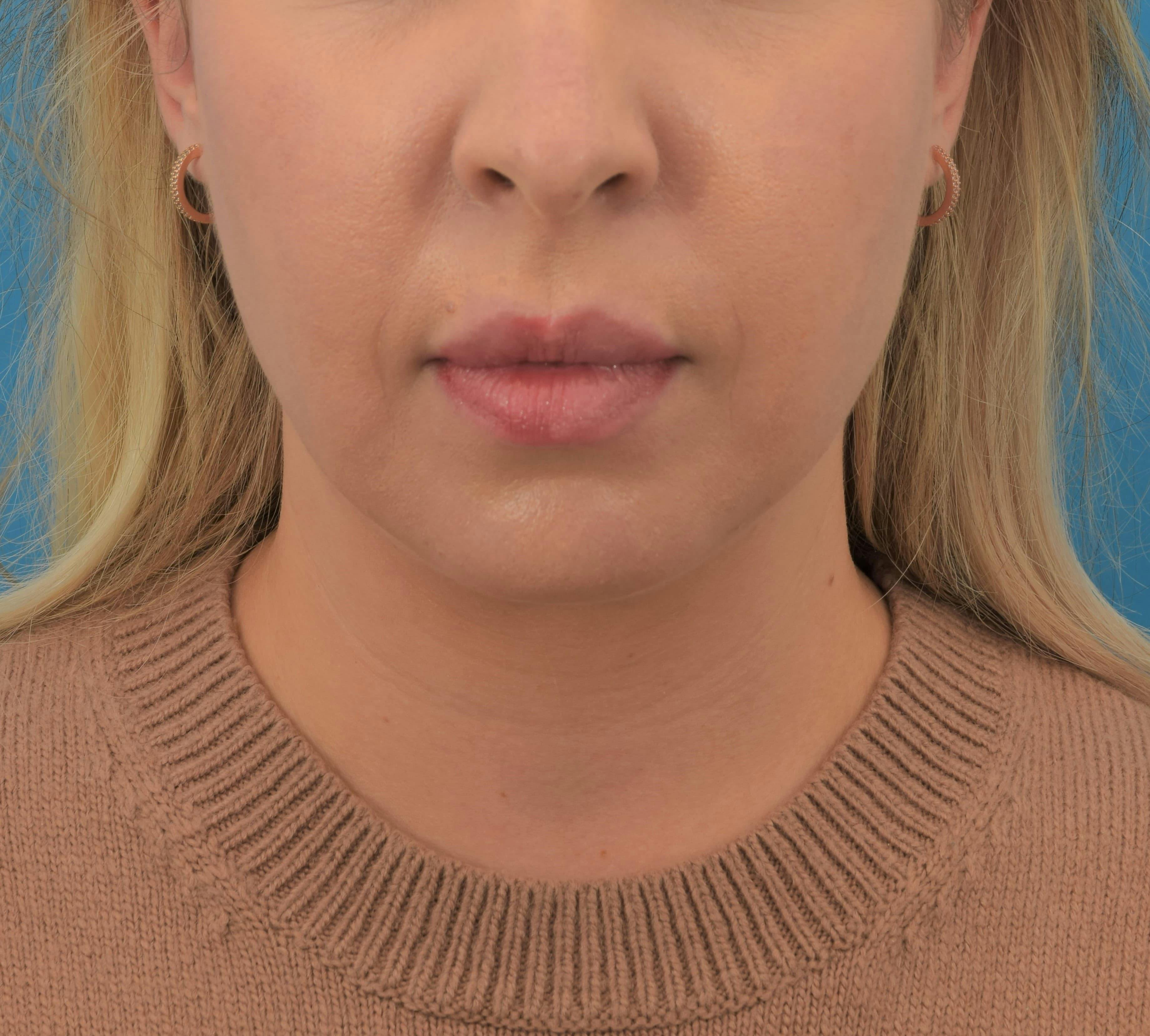 Buccal Fat Reduction