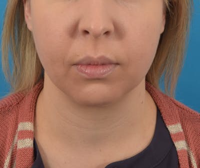 Buccal Fat Reduction Before & After Gallery - Patient 89845697 - Image 1