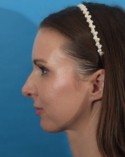 Rhinoplasty Before & After Gallery - Patient 111385917 - Image 1