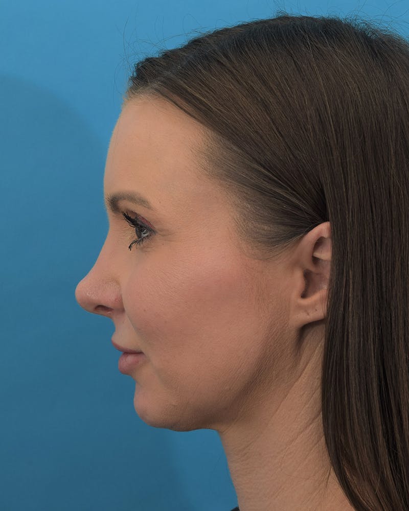 Rhinoplasty Before & After Gallery - Patient 111385917 - Image 4
