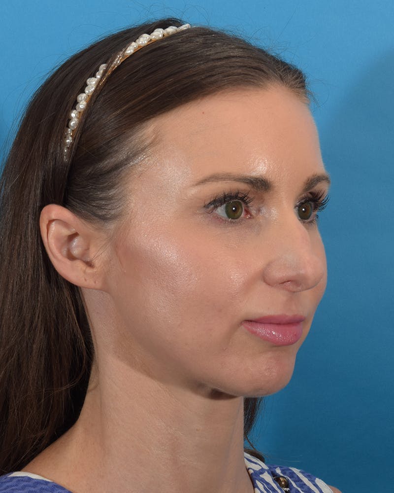 Dr. Frankel's Rhinoplasty in Cleveland Before and After 02