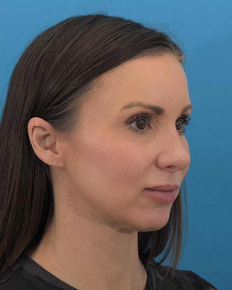 Dr. Frankel's Rhinoplasty in Cleveland Before and After 02