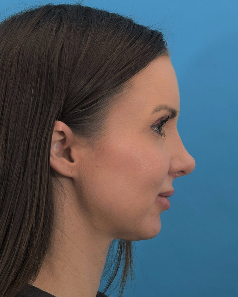 Rhinoplasty Before & After Gallery - Patient 111385917 - Image 2