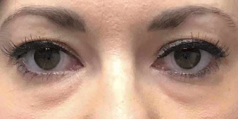 Blepharoplasty Before & After Gallery - Patient 120183175 - Image 1