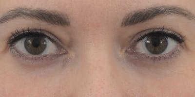 Blepharoplasty Before & After Gallery - Patient 120183175 - Image 2