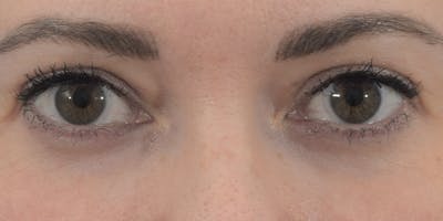 Blepharoplasty Before & After Gallery - Patient 120183175 - Image 2