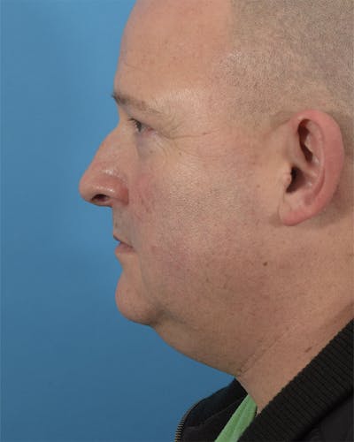 Rhinoplasty Before & After Gallery - Patient 120902549 - Image 1