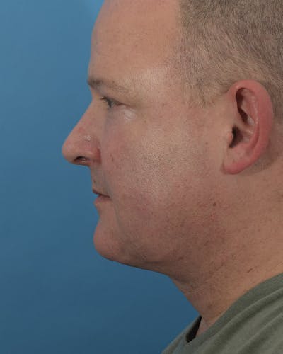 Facelift/Neck Lift Before & After Gallery - Patient 120902566 - Image 2