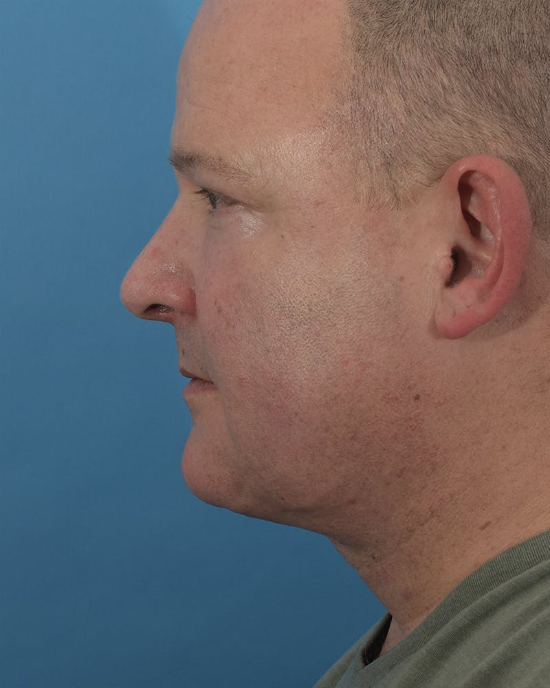Laser Treatment Before & After Gallery - Patient 120902609 - Image 2