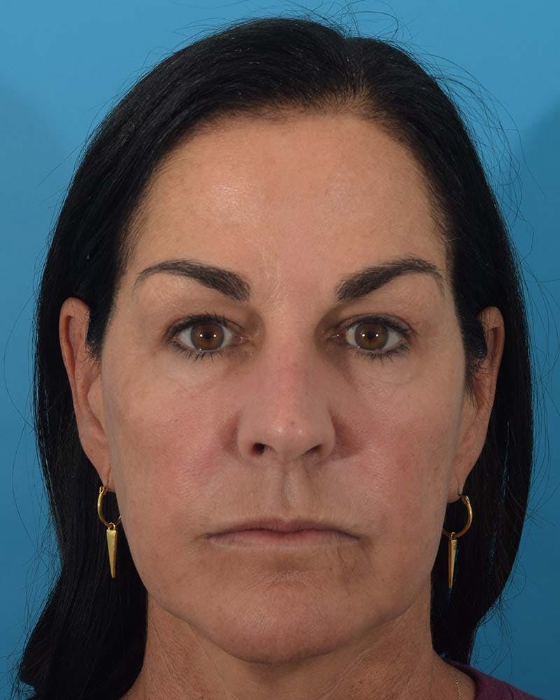 Laser Treatment Before & After Gallery - Patient 121543859 - Image 2