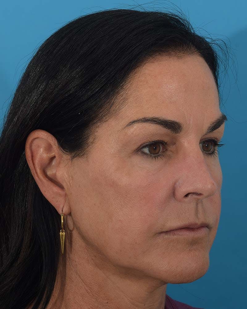 Skin Resurfacing Before & After Gallery - Patient 121543859 - Image 4