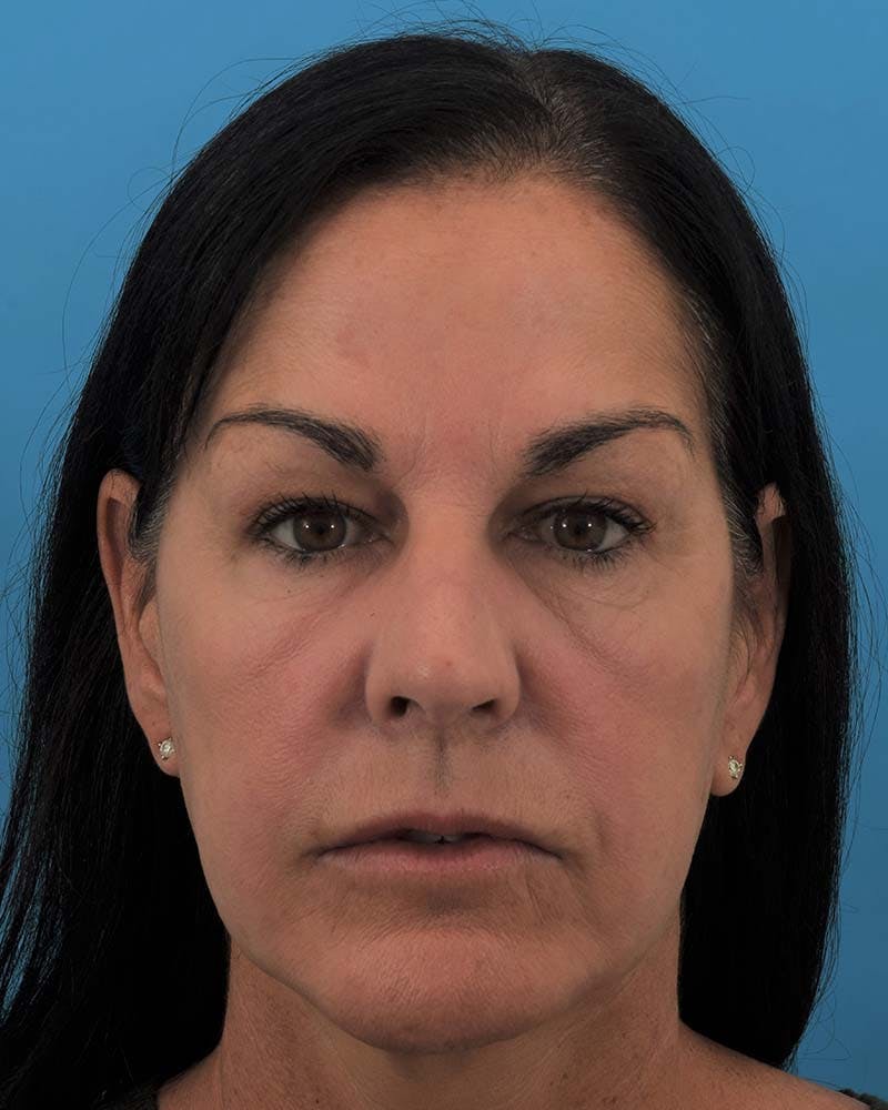 Laser Treatment Before & After Gallery - Patient 121543859 - Image 1