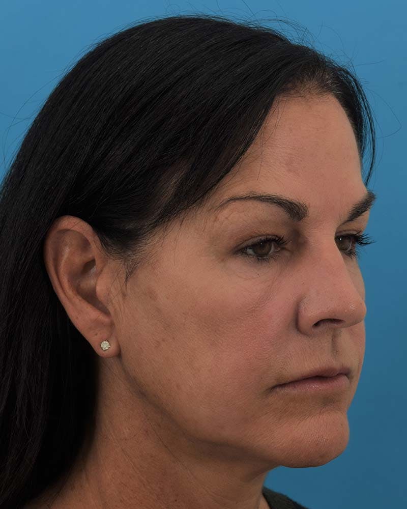 Skin Resurfacing Before & After Gallery - Patient 121543859 - Image 3