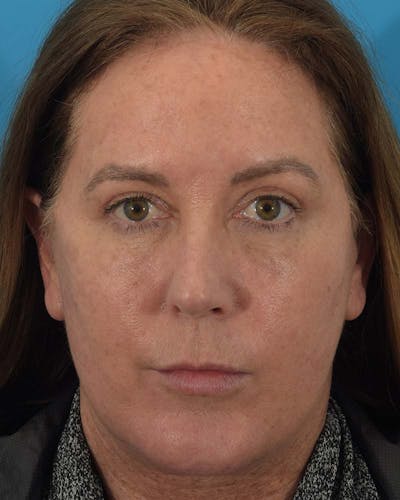 Otoplasty Before & After Gallery - Patient 121543971 - Image 2