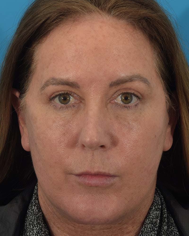 Facelift/Neck Lift Before & After Gallery - Patient 121543975 - Image 2