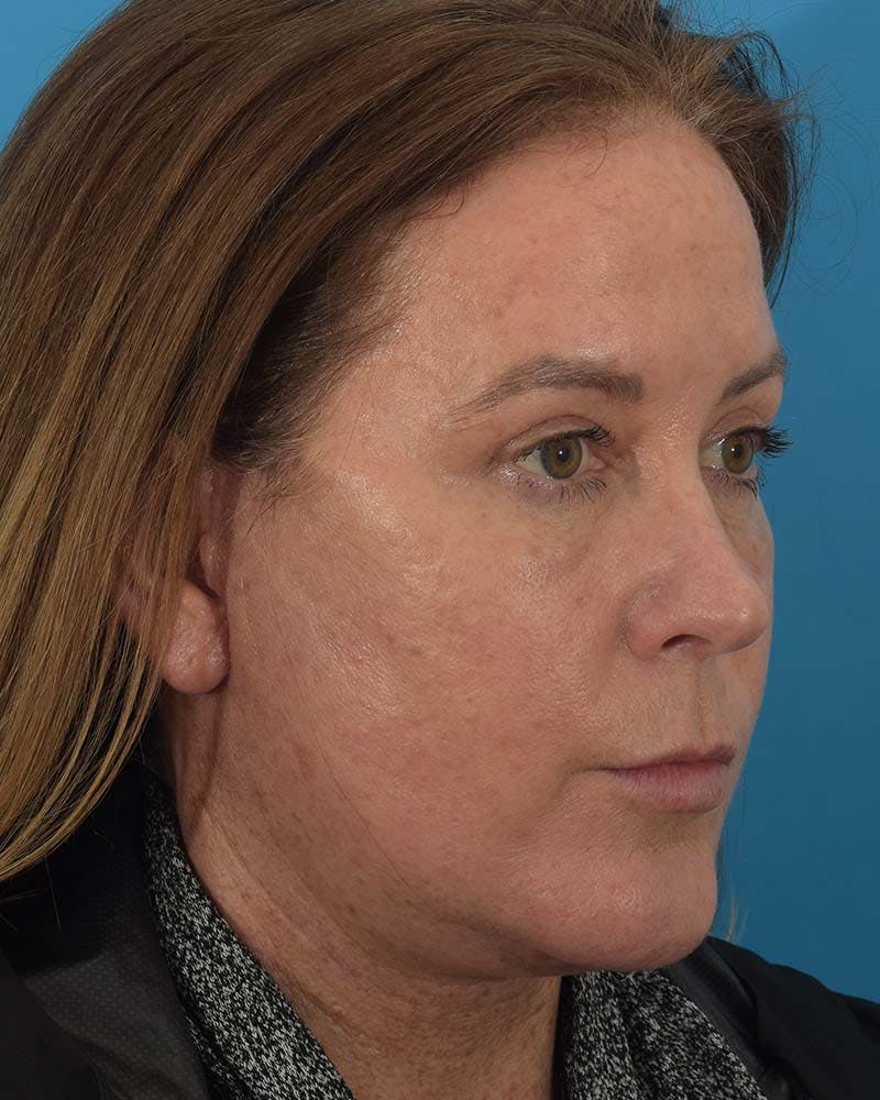Facelift/Neck Lift Before & After Gallery - Patient 121543975 - Image 4