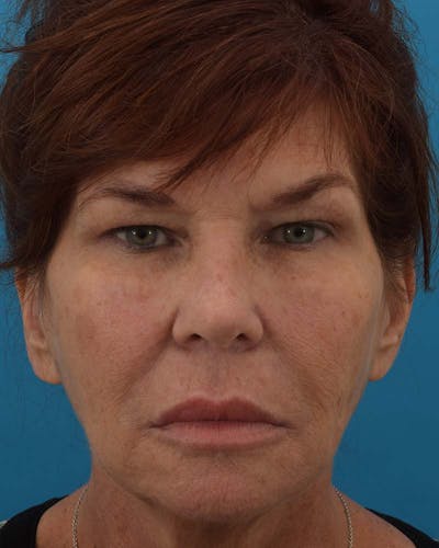 Facelift/Neck Lift Before & After Gallery - Patient 121765183 - Image 1