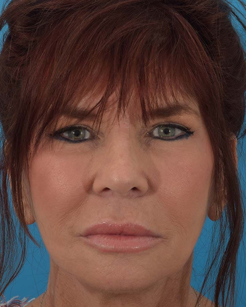 Facelift/Neck Lift Before & After Gallery - Patient 121765183 - Image 2