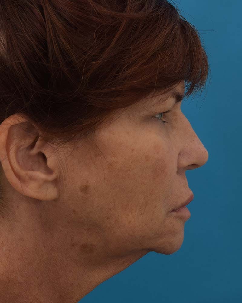 Skin Resurfacing Before & After Gallery - Patient 121765196 - Image 5