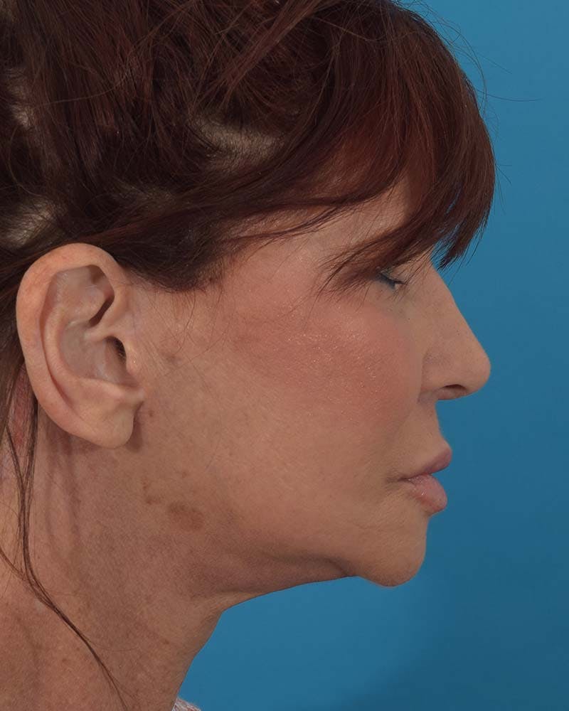 Facelift/Neck Lift Before & After Gallery - Patient 121765183 - Image 6