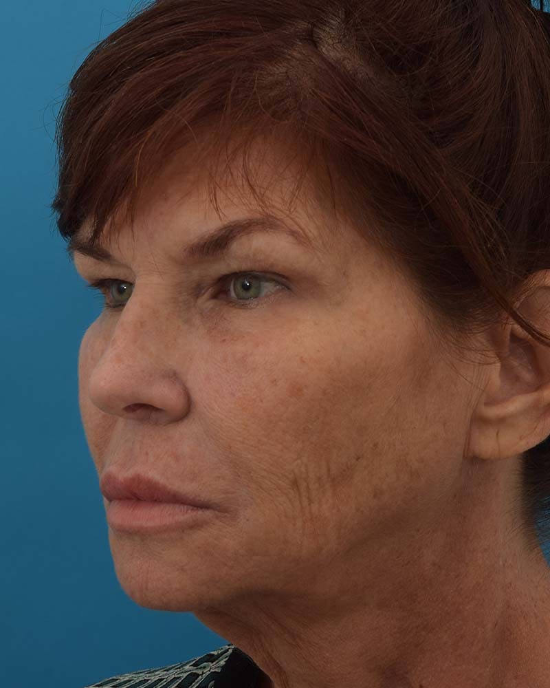 Facelift/Neck Lift Before & After Gallery - Patient 121765183 - Image 7