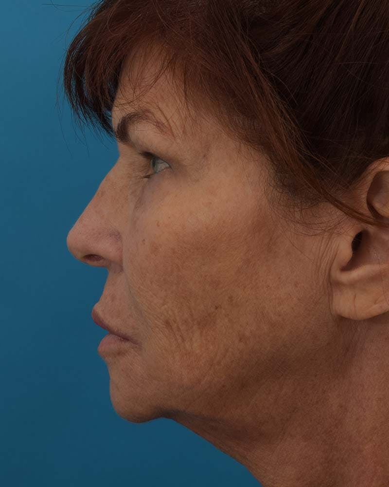 Skin Resurfacing Before & After Gallery - Patient 121765196 - Image 9