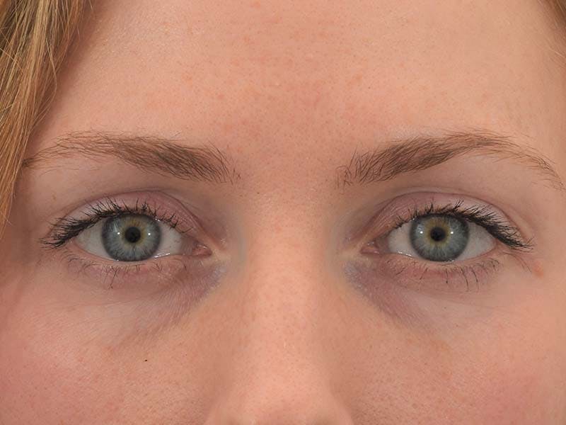 Blepharoplasty Before & After Gallery - Patient 121765383 - Image 1