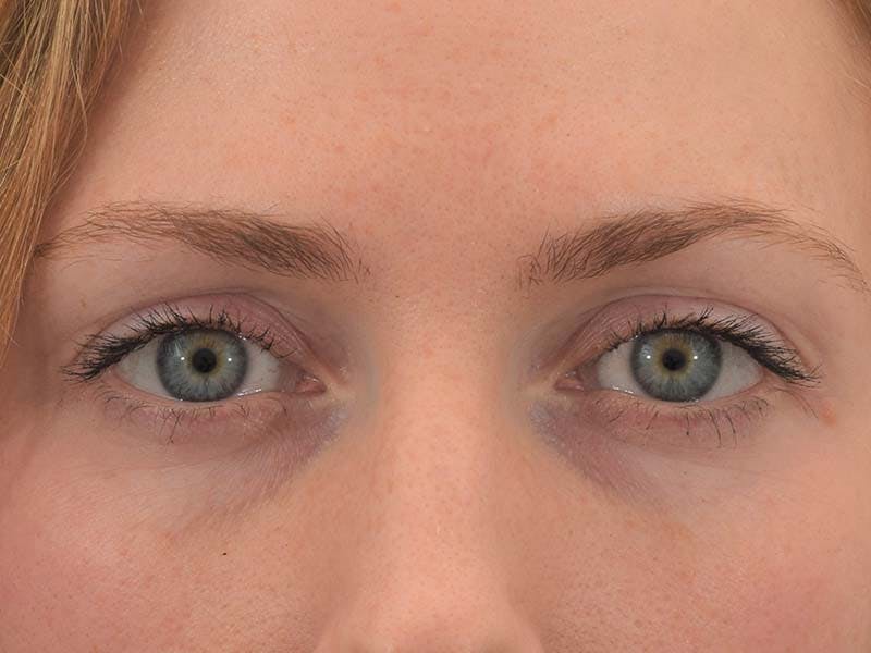 Dr. Frankel Eyelid Surgery 01