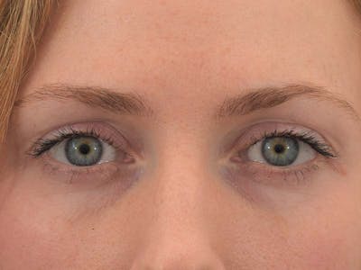 Blepharoplasty Before & After Gallery - Patient 121765383 - Image 1
