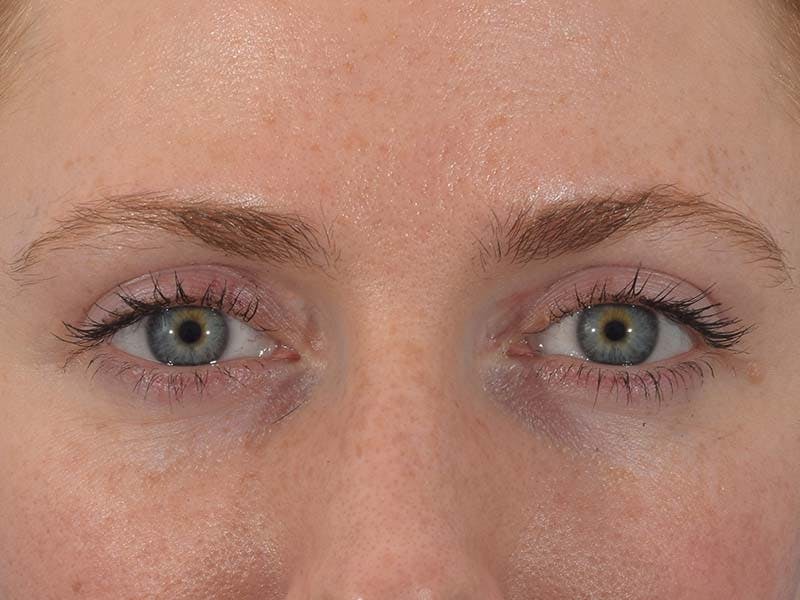 Dr. Frankel Eyelid Surgery 01