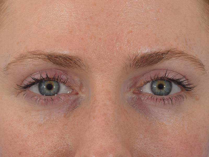 Blepharoplasty Before & After Gallery - Patient 121765383 - Image 2