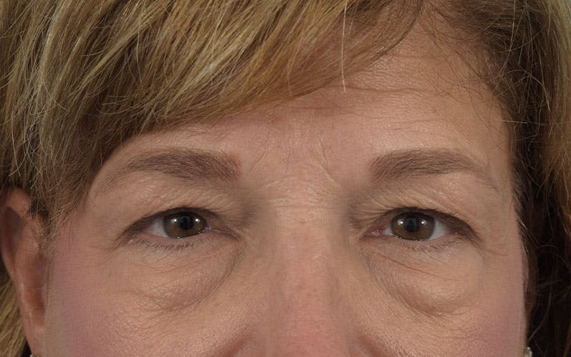 Blepharoplasty Before & After Gallery - Patient 121840959 - Image 1
