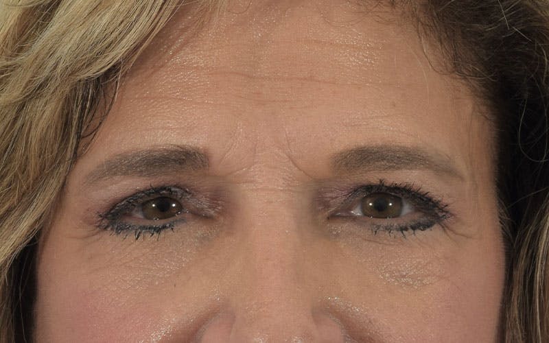 Blepharoplasty Before & After Gallery - Patient 121840959 - Image 2
