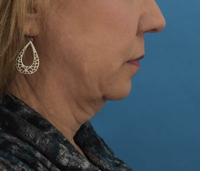 Facelift/Neck Lift Before & After Gallery - Patient 122030899 - Image 1