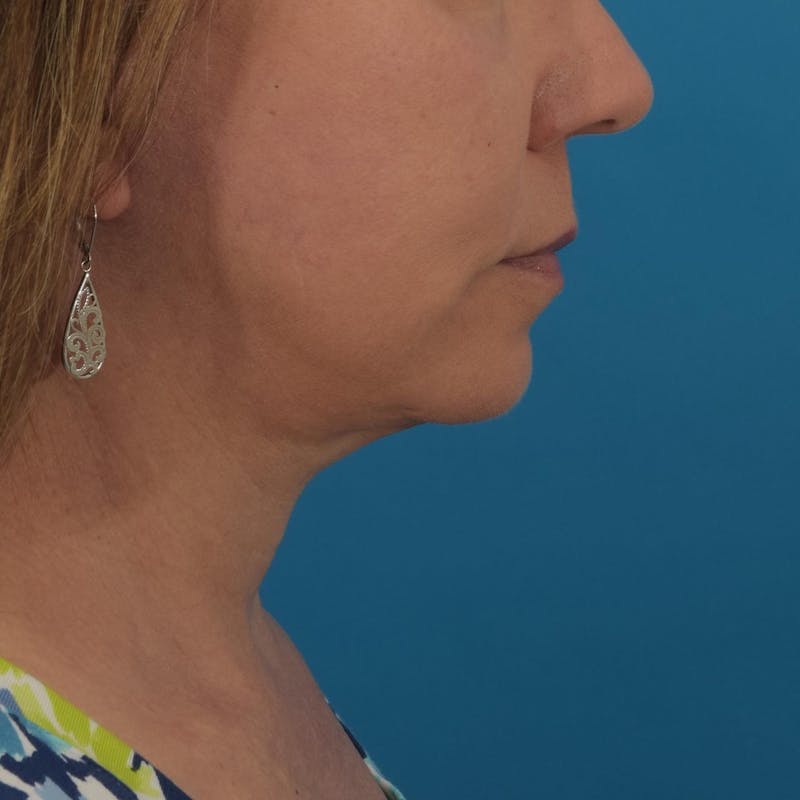 Facelift/Neck Lift Before & After Gallery - Patient 122030899 - Image 2