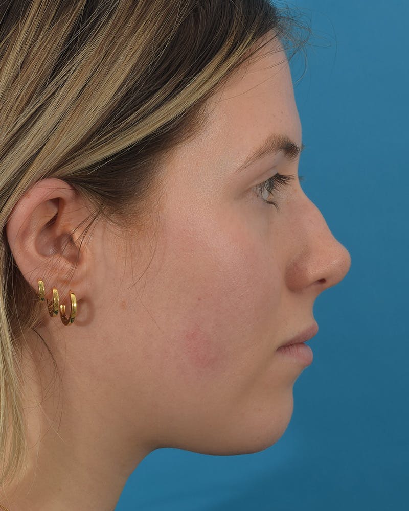 Rhinoplasty Before & After Gallery - Patient 122751079 - Image 1