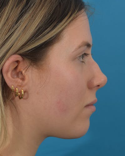 Rhinoplasty Before & After Gallery - Patient 122751079 - Image 1