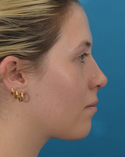 Rhinoplasty Before & After Gallery - Patient 122751079 - Image 2
